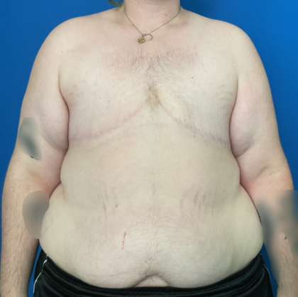 FTM Before & After Patient #1887