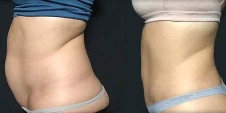 B&A slide