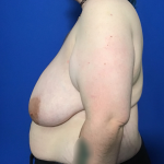 FTM Before & After Patient #1887