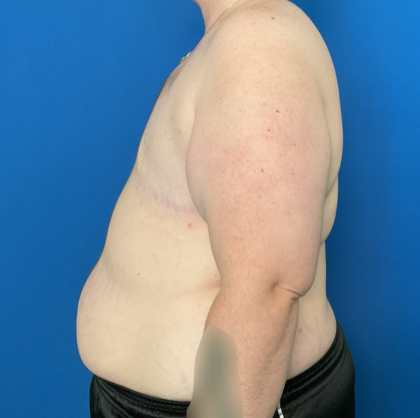 FTM Before & After Patient #1887