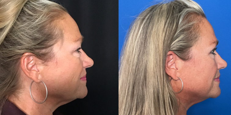 B&A slide