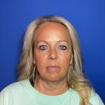 Blepharoplasty Before & After Patient #1905