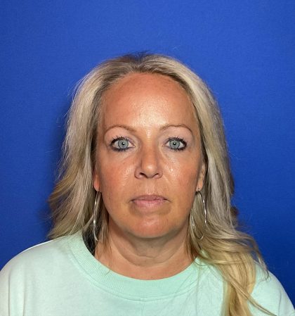 Blepharoplasty Before & After Patient #1905