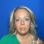 Blepharoplasty Before & After Patient #1905
