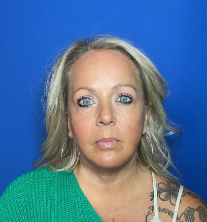 Blepharoplasty Before & After Patient #1905