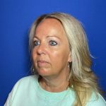 Blepharoplasty Before & After Patient #1905