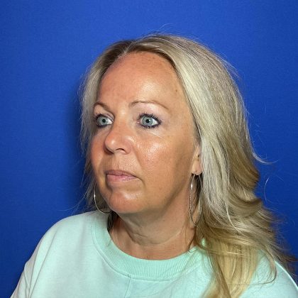 Blepharoplasty Before & After Patient #1905