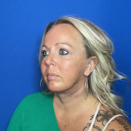 Blepharoplasty Before & After Patient #1905