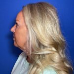Blepharoplasty Before & After Patient #1905