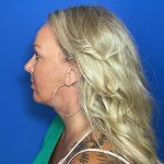 Blepharoplasty Before & After Patient #1905