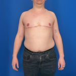 FTM Before & After Patient #1923