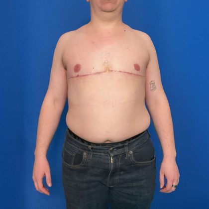 FTM Before & After Patient #1923