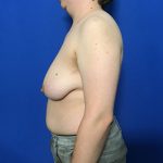 FTM Before & After Patient #1923
