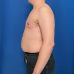 FTM Before & After Patient #1923
