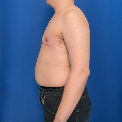 FTM Before & After Patient #1923