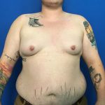 FTM Before & After Patient #1939