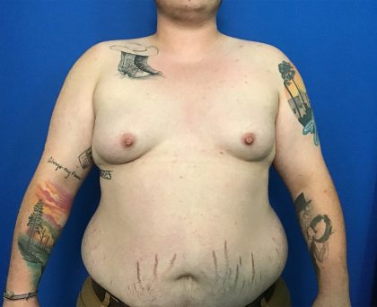 FTM Before & After Patient #1939