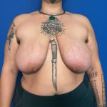 Breast Reduction Before & After Patient #1943