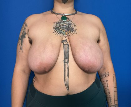 Breast Reduction Before & After Patient #1943