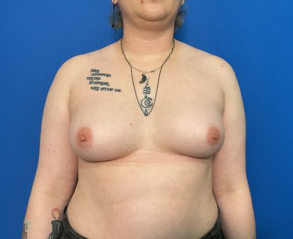 FTM Before & After Patient #1944
