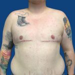 FTM Before & After Patient #1939