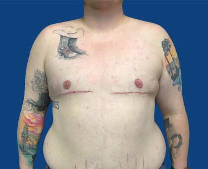 FTM Before & After Patient #1939