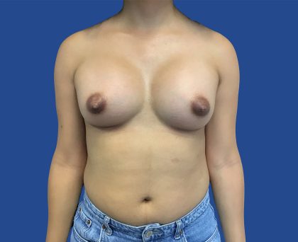 MTF Before & After Patient #1941
