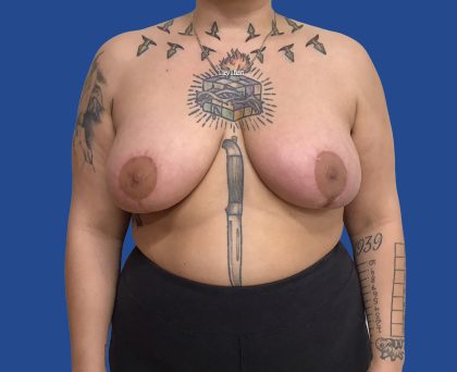 Breast Reduction Before & After Patient #1943