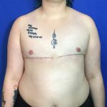 FTM Before & After Patient #1944