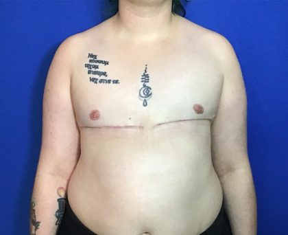 FTM Before & After Patient #1944