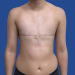 FTM Before & After Patient #1945