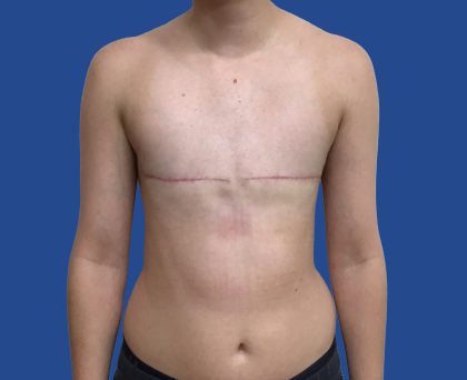 FTM Before & After Patient #1945