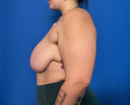 Breast Reduction Before & After Patient #1943