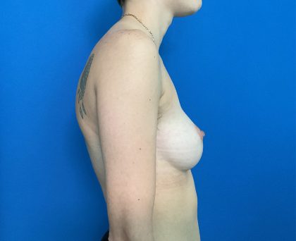 FTM Before & After Patient #1945