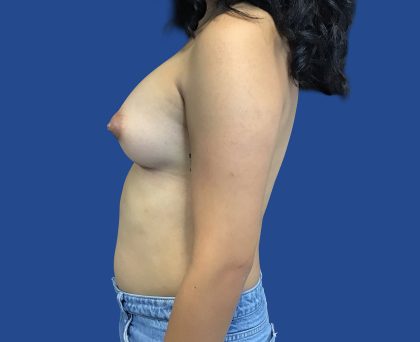 MTF Before & After Patient #1941