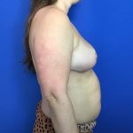 Breast Reduction Before & After Patient #1942