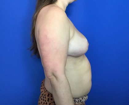 Breast Reduction Before & After Patient #1942