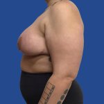 Breast Reduction Before & After Patient #1943