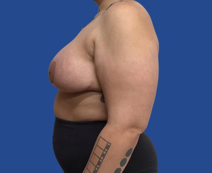 Breast Reduction Before & After Patient #1943