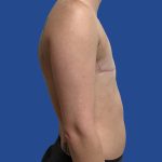 FTM Before & After Patient #1945