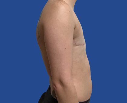 FTM Before & After Patient #1945