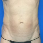 Abdominoplasty Before & After Patient #2032