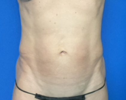 Abdominoplasty Before & After Patient #2032