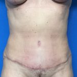 Abdominoplasty Before & After Patient #2032