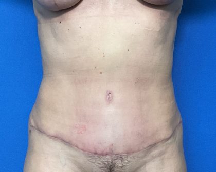 Abdominoplasty Before & After Patient #2032
