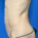 Abdominoplasty Before & After Patient #2032