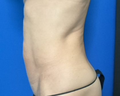 Abdominoplasty Before & After Patient #2032