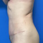 Abdominoplasty Before & After Patient #2032