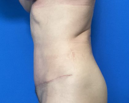 Abdominoplasty Before & After Patient #2032