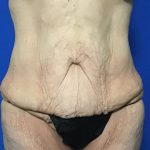 Abdominoplasty Before & After Patient #2033